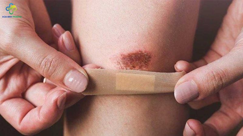 Trĩ Ngoại, Vết Thương Hở – Hỗ Trợ An Toàn Từ Cao Lá Thuần Mộc