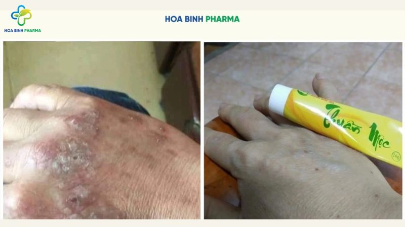 Làn da mất nước nhanh chóng, khiến bề mặt da trở nên sần sùi, bong tróc, thậm chí nứt nẻ