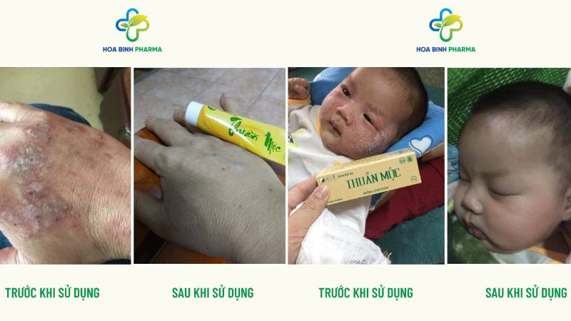 Kem bôi da Thuần Mộc không chỉ được đánh giá cao về độ hiệu quả mà còn gây ấn tượng bởi độ an toàn và phù hợp với làn da người Việt
