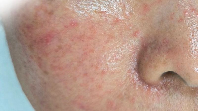 Làn da nhạy cảm hoặc vùng da tổn thương sử dụng sản phẩm trôi nổi, không được kiểm định sẽ dễ dẫn đến nhiễm trùng và viêm da