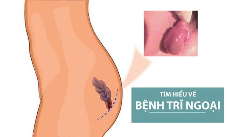 Trĩ ngoại hình thành do sự giãn nở và sưng phồng của tĩnh mạch nằm dưới da quanh hậu môn