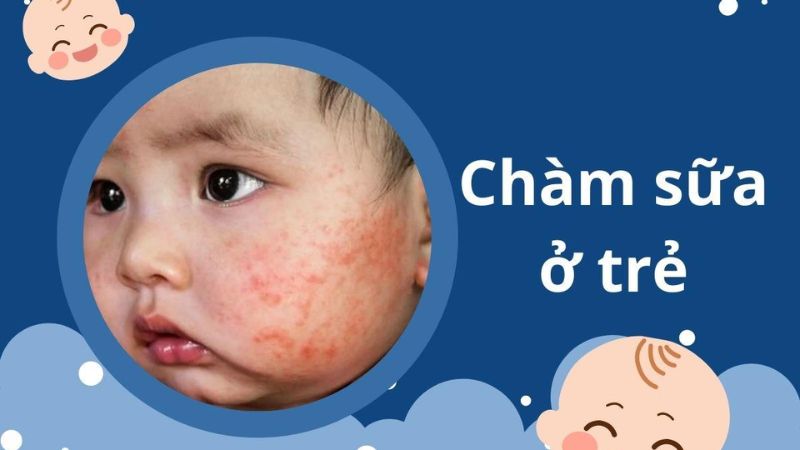Chàm Sữa Ở Trẻ Sơ Sinh: Nguyên Nhân, Cách Chăm & Sản Phẩm An Toàn